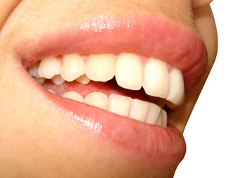 Отстраняване на зъбната плака